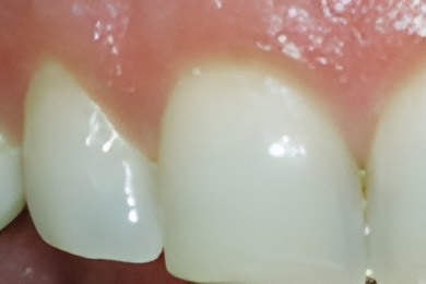 Teeth Whitening in San Jose