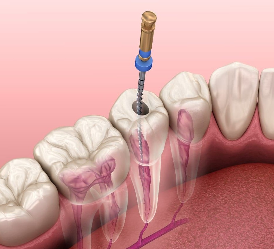 Root canal therapy in San Jose
